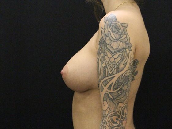 Breast Augmentation: Case 27 - After