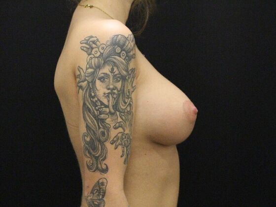 Breast Augmentation: Case 27 - After