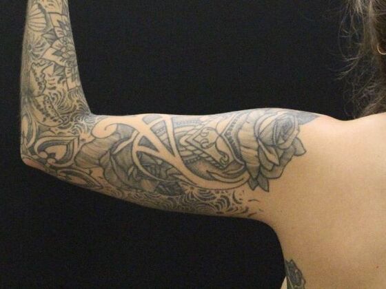 Arm Lift & Reduction: Case 9 - After