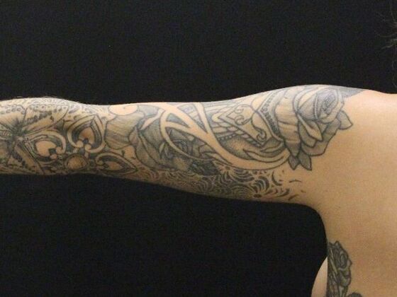 Arm Lift & Reduction: Case 9 - After