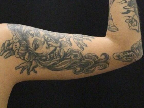 Arm Lift & Reduction: Case 9 - After