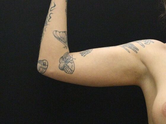 Arm Lift & Reduction Case 9 - After