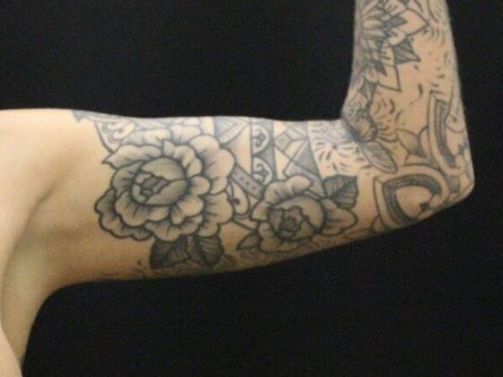 Arm Lift & Reduction: Case 9 - After