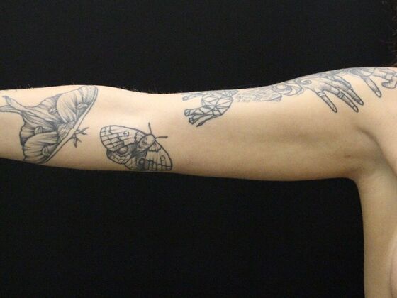 Arm Lift & Reduction: Case 9 - After