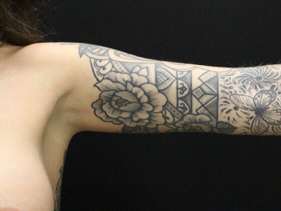 Arm Lift & Reduction: Case 9 - After