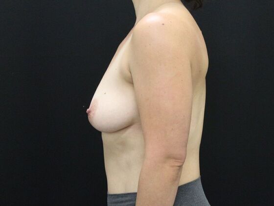 Breast Lift & Breast Lift Augmentation: Case 44 - Before