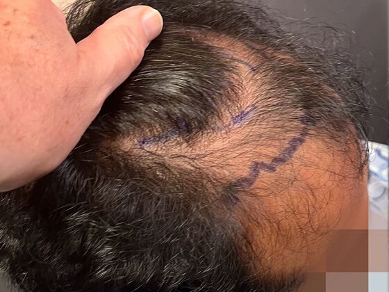 FUE Hair Restoration: Case 41 - Before