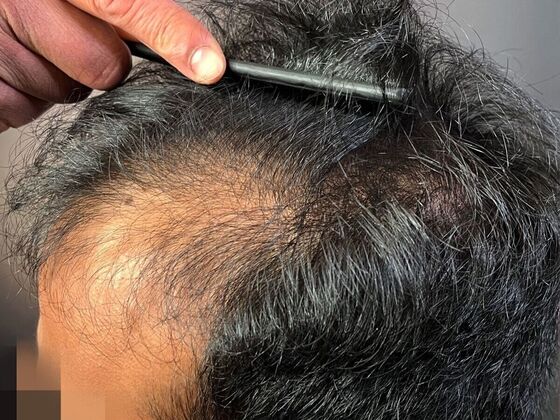 FUE Hair Restoration: Case 41 - Before