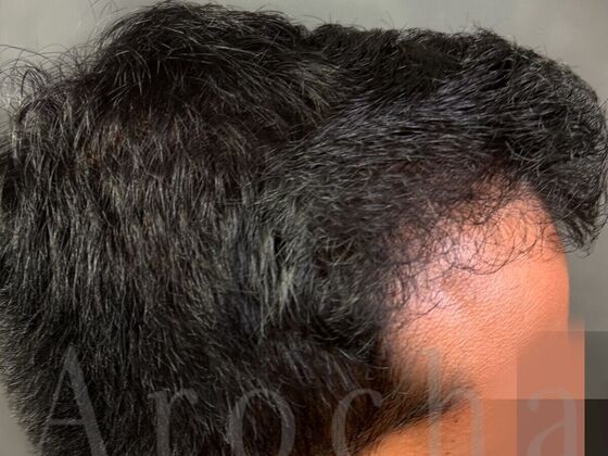 FUE Hair Restoration: Case 41 - After