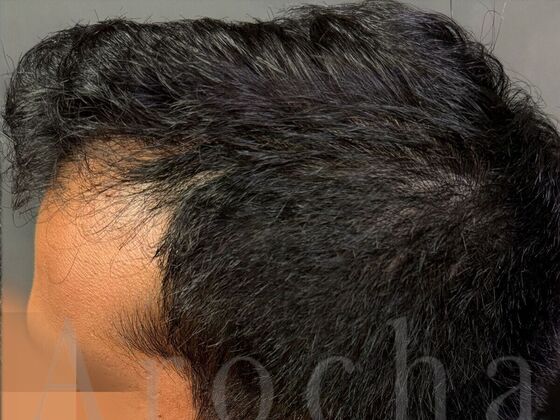 FUE Hair Restoration: Case 41 - After