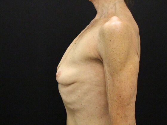 Breast Lift & Breast Lift Augmentation: Case 45 - Before