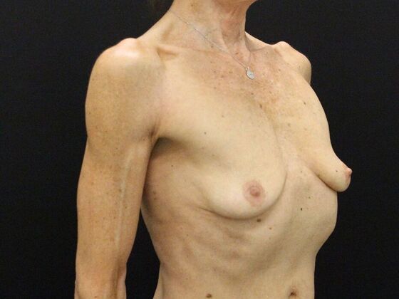 Breast Lift & Breast Lift Augmentation: Case 45 - Before