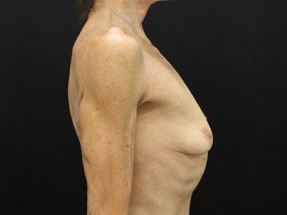 Breast Lift & Breast Lift Augmentation: Case 45 - Before