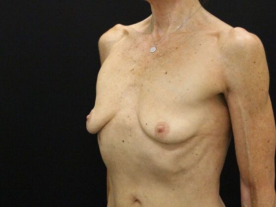 Breast Lift & Breast Lift Augmentation: Case 45 - Before