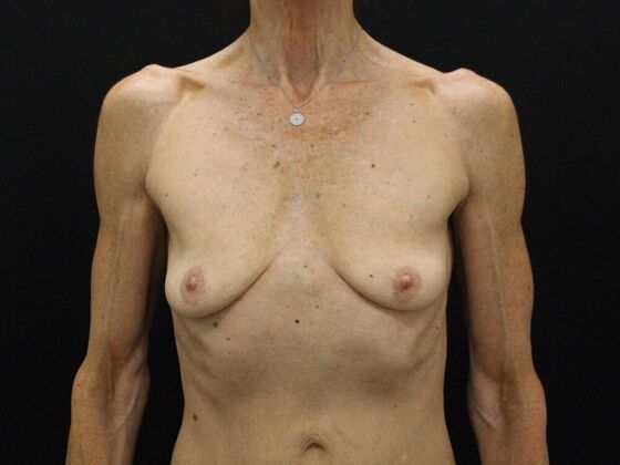 Breast Lift & Breast Lift Augmentation Case 45 - Before