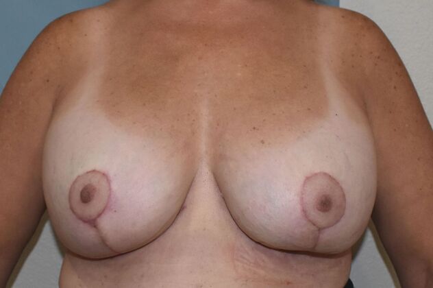 Breast Revision: Case 257 - After
