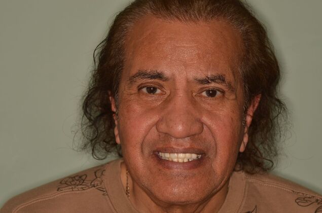 Hybrid Porcelain teeth on dental implants Case 2 - Before