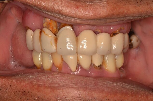 Hybrid Porcelain teeth on dental implants: Case 2 - Before treatment with broken decayed porcelain crowns