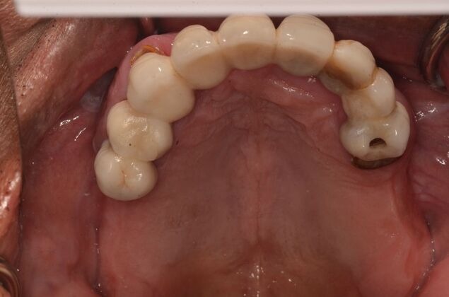 Hybrid Porcelain teeth on dental implants: Case 2 - Before treatment