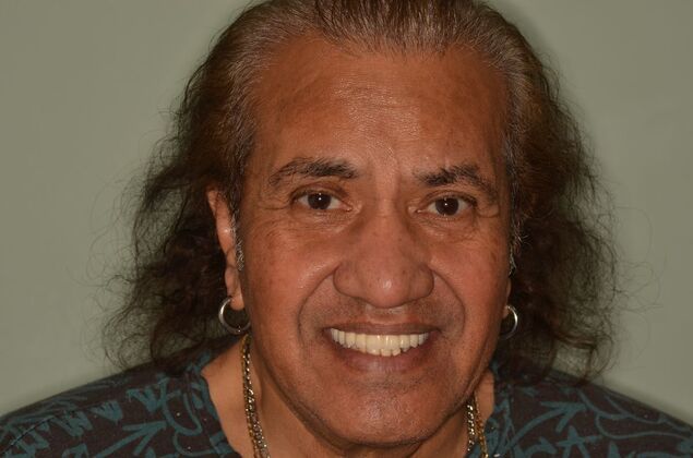 Hybrid Porcelain teeth on dental implants Case 2 - After