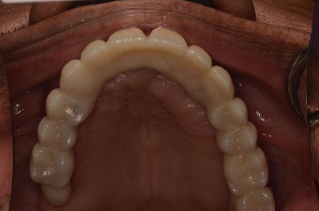 Hybrid Porcelain teeth on dental implants: Case 2 - After with upper hybrid