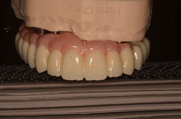 Hybrid Porcelain teeth on dental implants: Case 2 - Hybrid on model