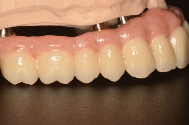 Hybrid Porcelain teeth on dental implants: Case 2 - Hybrid on model