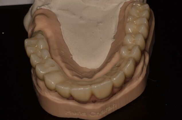 Hybrid Porcelain teeth on dental implants: Case 2 - Hybrid on model