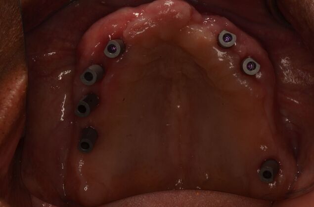 Hybrid Porcelain teeth on dental implants: Case 2 - Seven upper implants placed