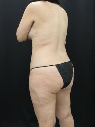 Tummy Tuck: Case 59 - Before