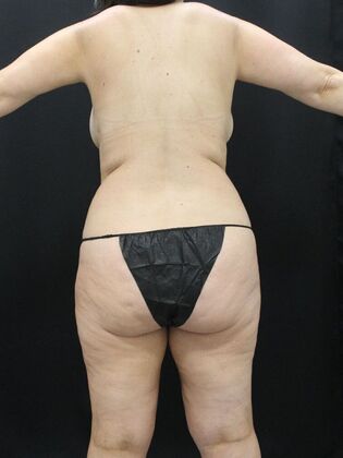 Tummy Tuck: Case 59 - Before