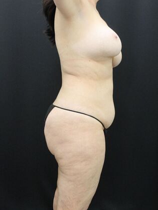 Tummy Tuck: Case 59 - Before