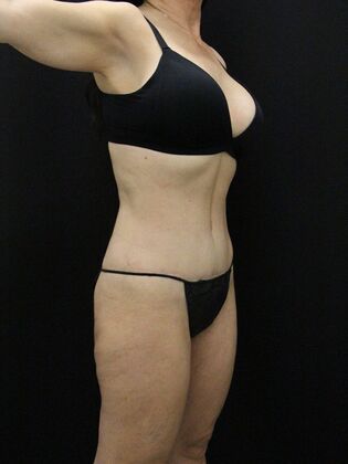 Tummy Tuck Case 59 - After
