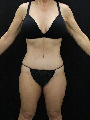 Tummy Tuck: Case 59 - After