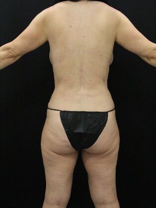 Tummy Tuck: Case 59 - After