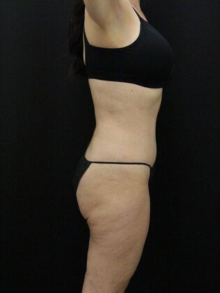 Tummy Tuck: Case 59 - After