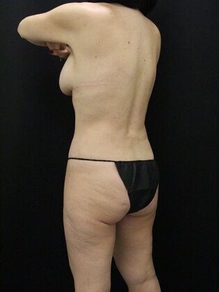 Tummy Tuck: Case 59 - After