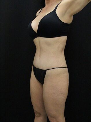 Tummy Tuck: Case 59 - After