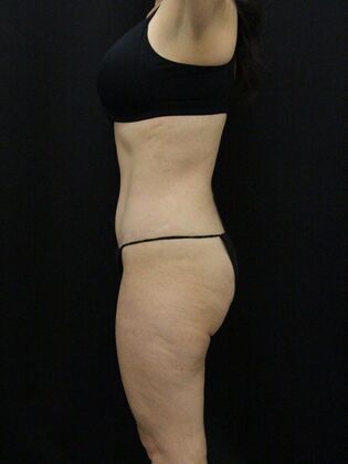 Tummy Tuck: Case 59 - After