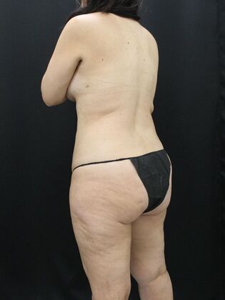 Liposuction: Case 50 - Before