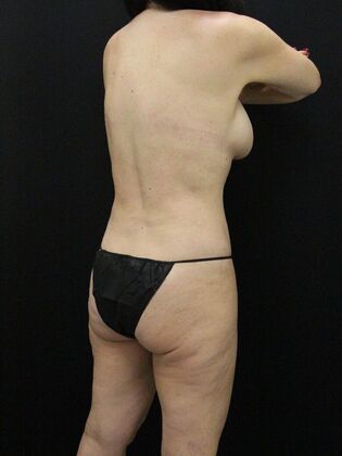 Liposuction Case 50 - After