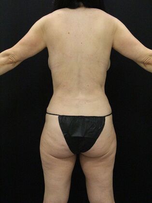 Liposuction: Case 50 - After