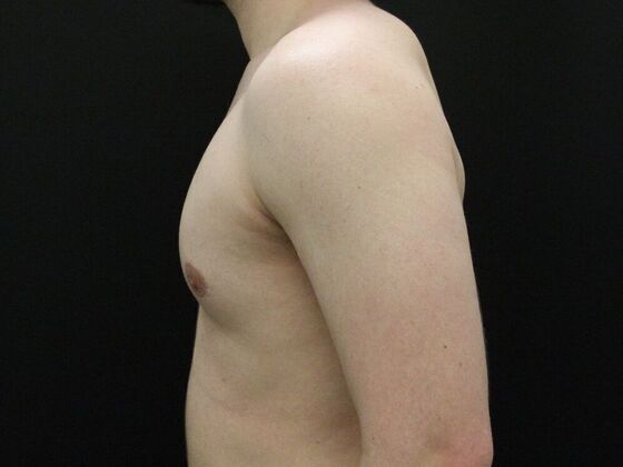Gynecomastia: Case 9 - Before