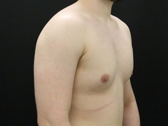 Gynecomastia: Case 9 - Before