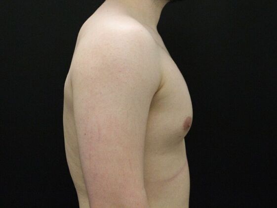 Gynecomastia: Case 9 - Before