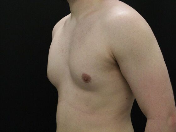 Gynecomastia: Case 9 - Before