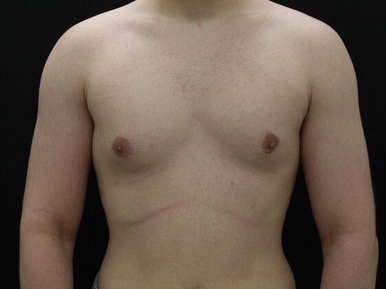 Gynecomastia Case 9 - Before