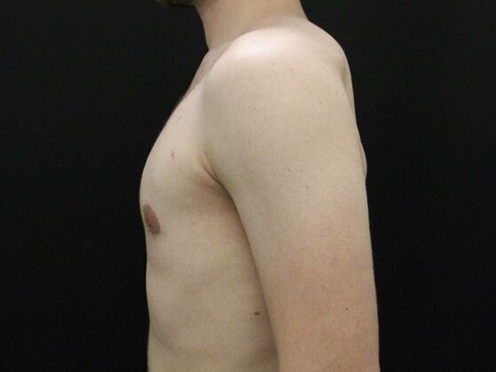 Gynecomastia: Case 9 - After