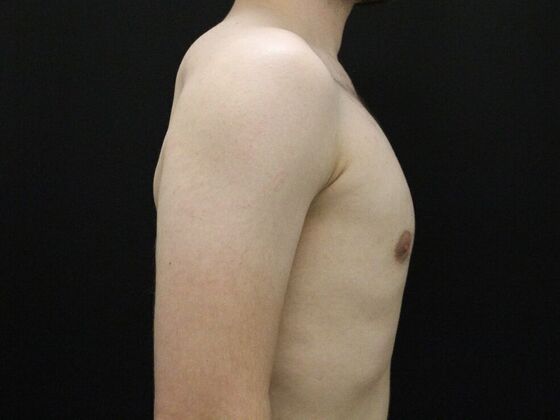Gynecomastia: Case 9 - After