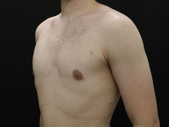 Gynecomastia: Case 9 - After